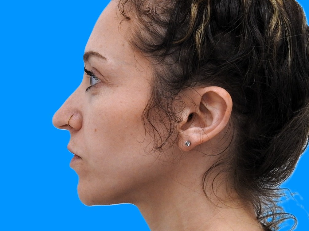 Before Image: Patient Case #0103 - left-side