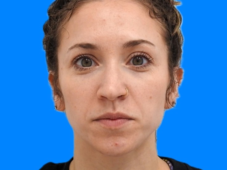 Before Image: Patient Case #0103 - front