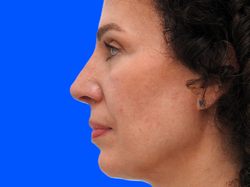 After Image: Patient Case #0104 - left-side