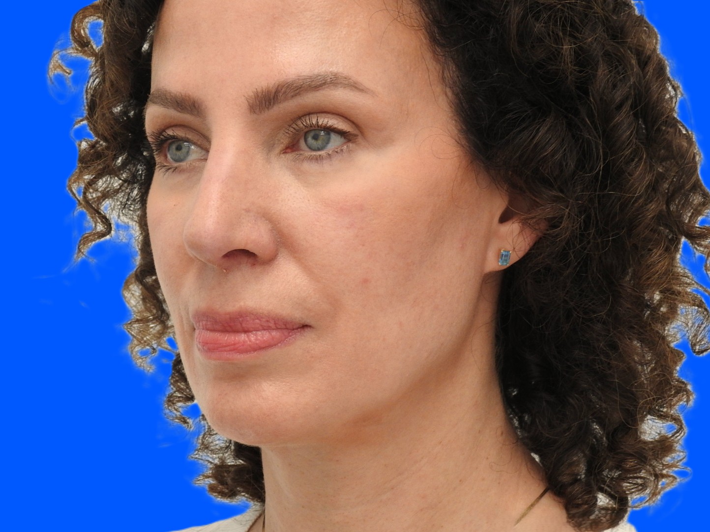 After Image: Patient Case #0104 - left-front-oblique