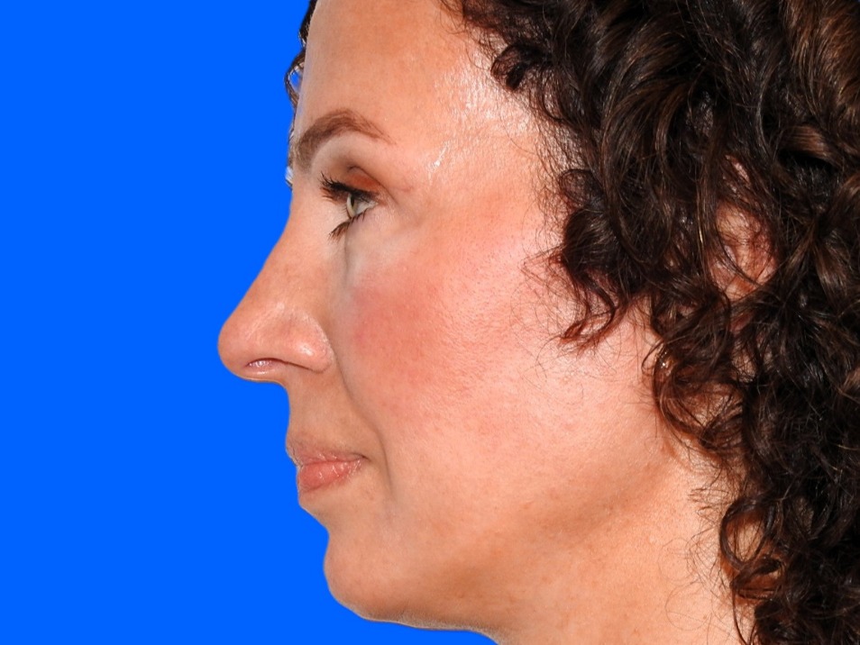 Before Image: Patient Case #0104 - left-side