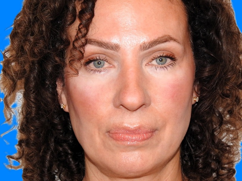 Before Image: Patient Case #0104 - front