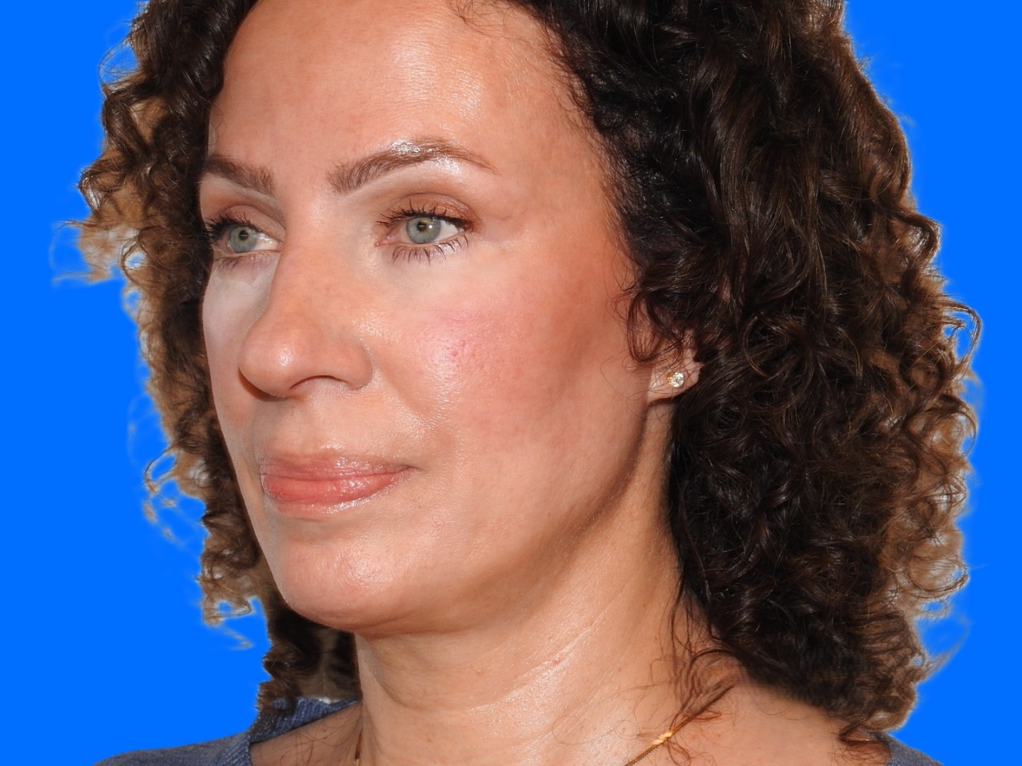 Before Image: Patient Case #0104 - left-front-oblique