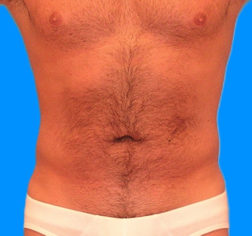 After Image: Patient Case #0105 - front