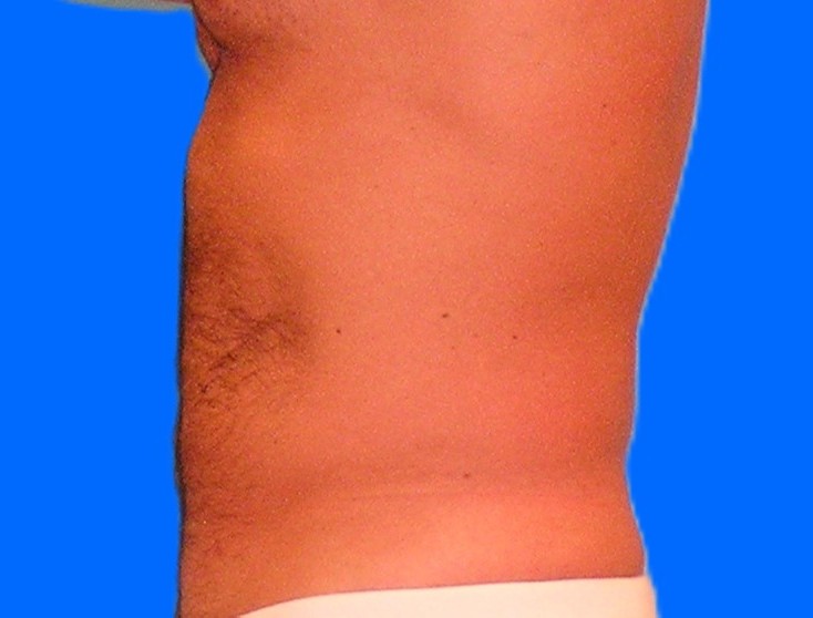 After Image: Patient Case #0105 - left-side