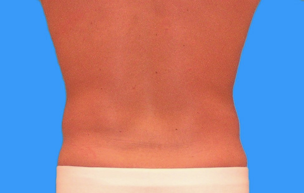 After Image: Patient Case #0105 - back