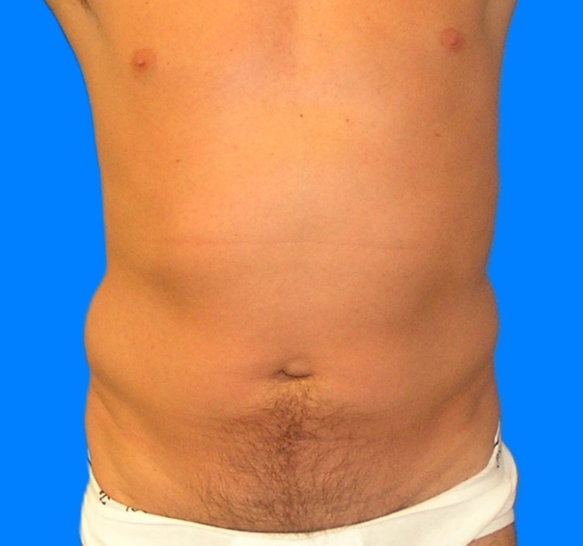 Before Image: Patient Case #0105 - front