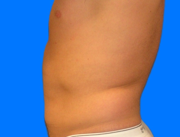 Before Image: Patient Case #0105 - left-side