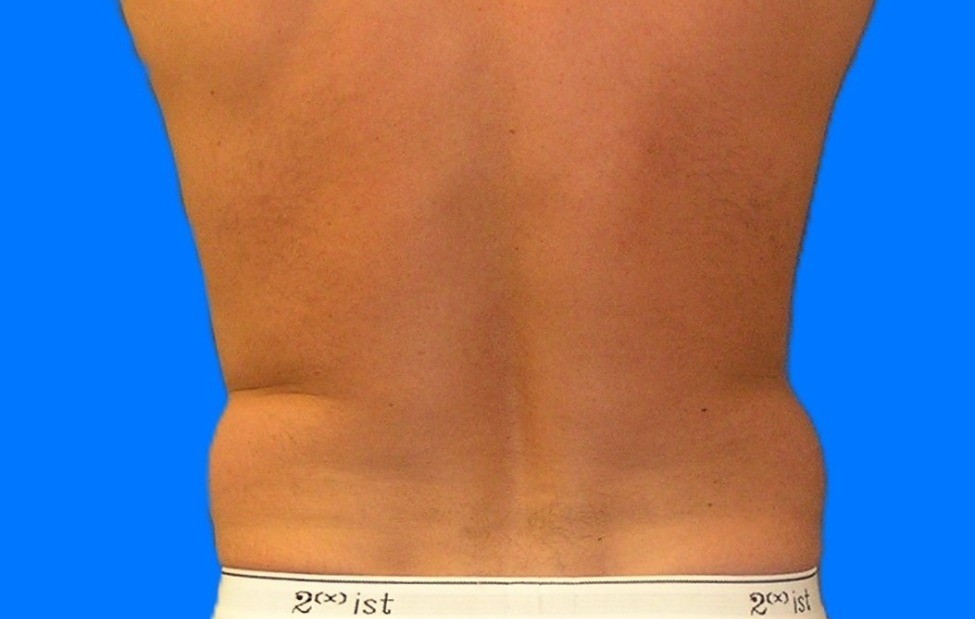 Before Image: Patient Case #0105 - back