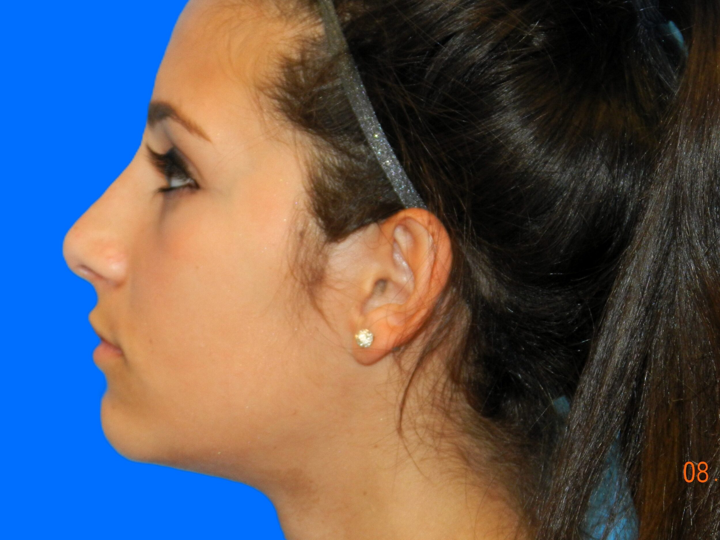 After Image: Patient Case #0107 - left-side