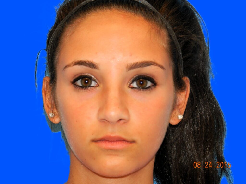 After Image: Patient Case #0107 - front