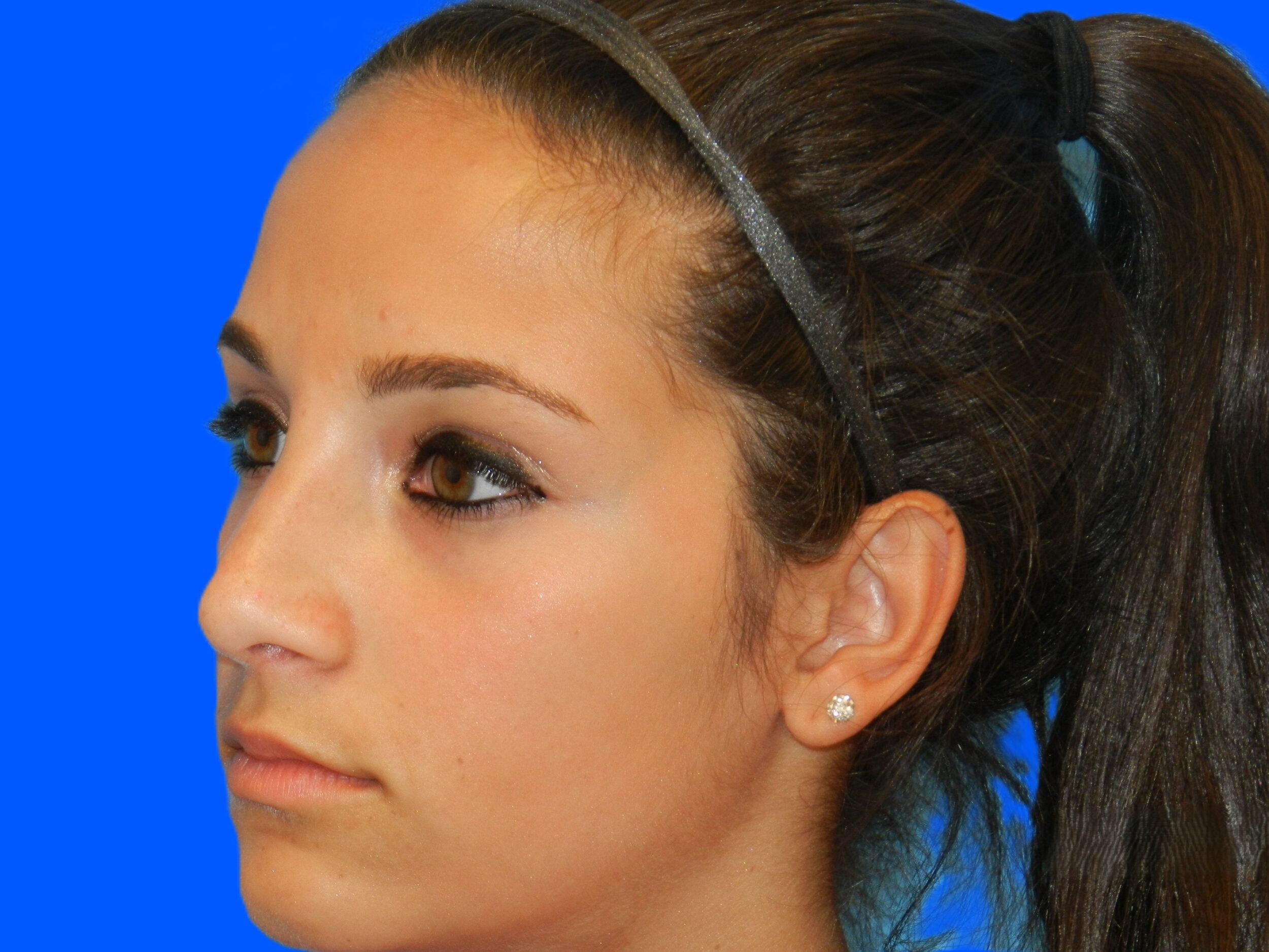 After Image: Patient Case #0107 - left-front-oblique