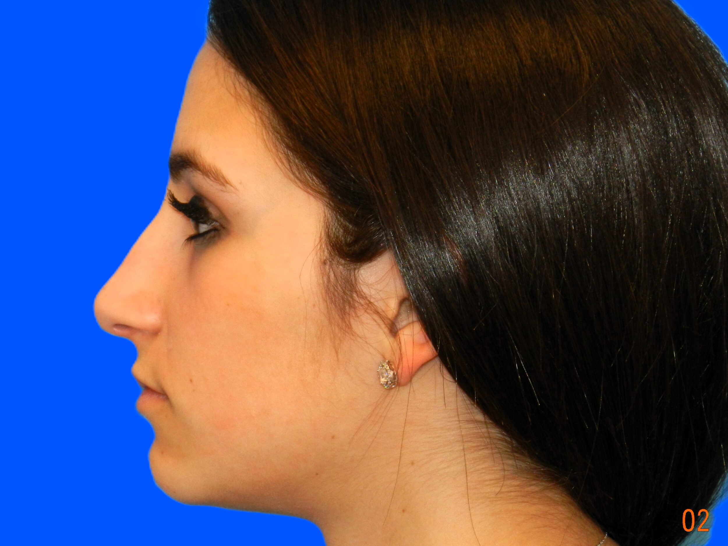 Before Image: Patient Case #0107 - left-side