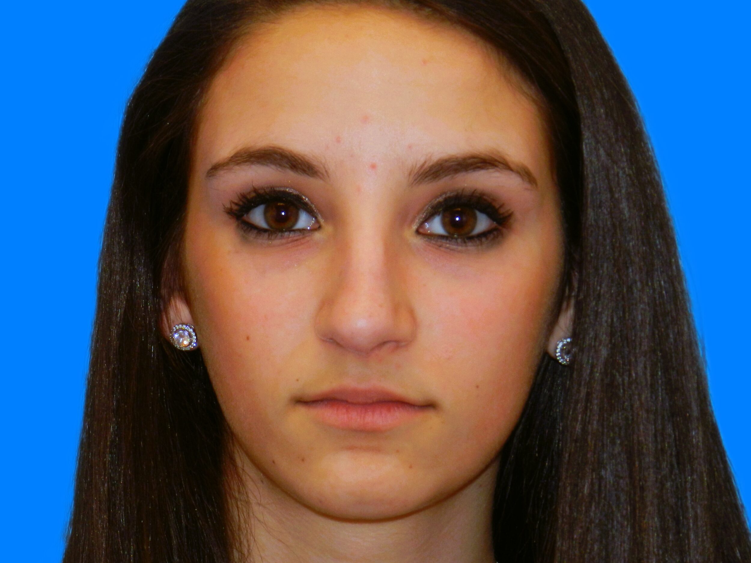 Before Image: Patient Case #0107 - front