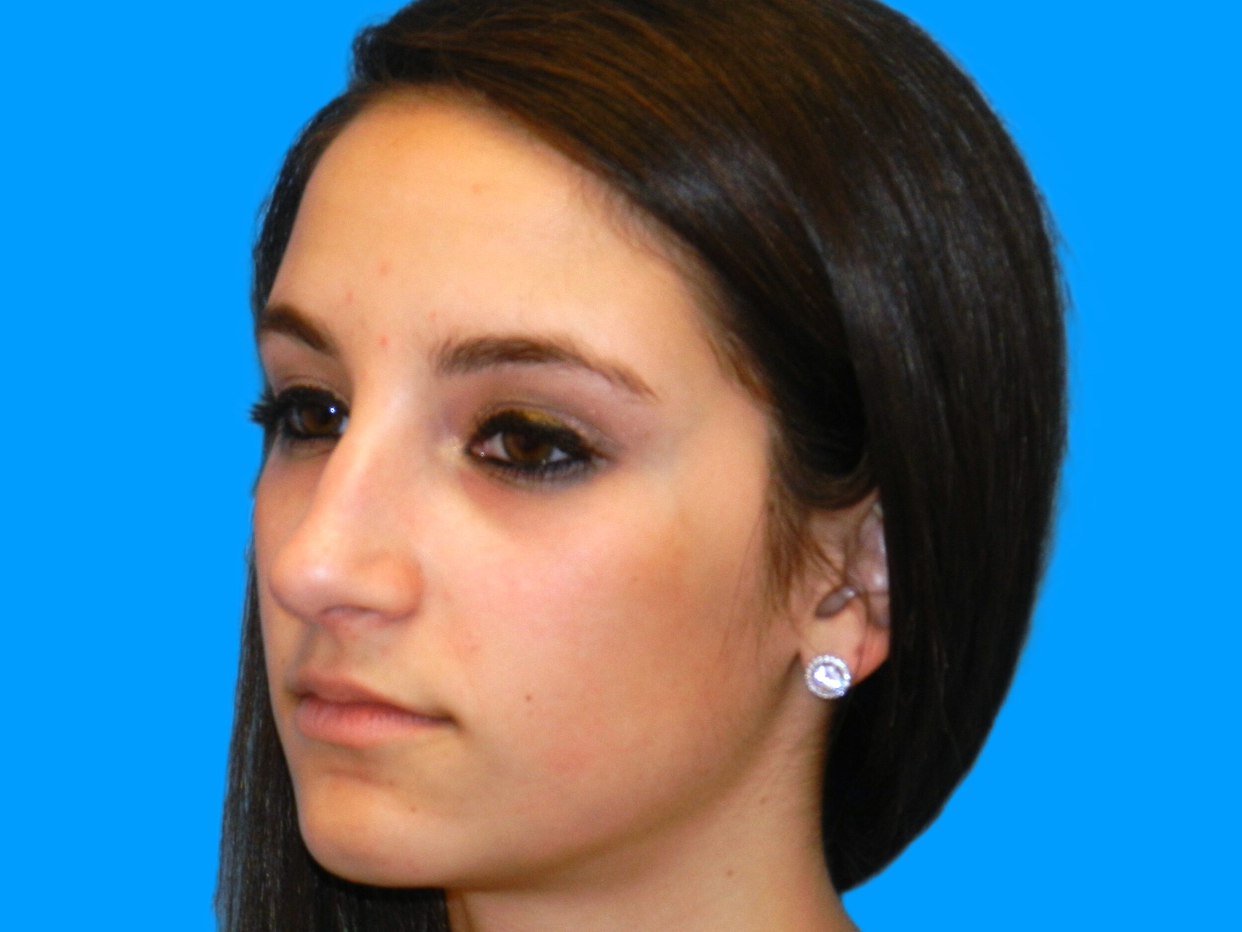 Before Image: Patient Case #0107 - left-front-oblique