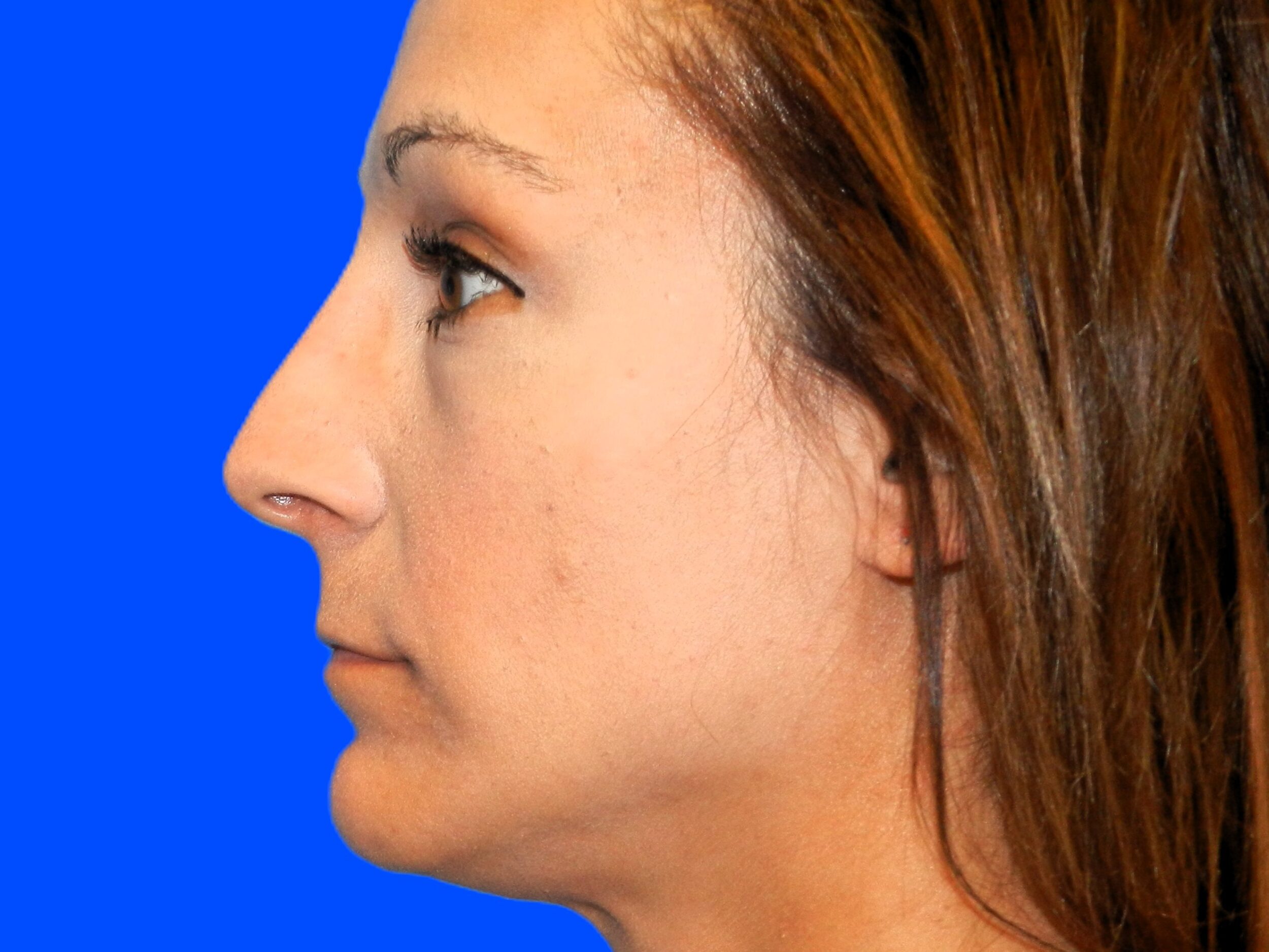 After Image: Patient Case #0108 - left-side