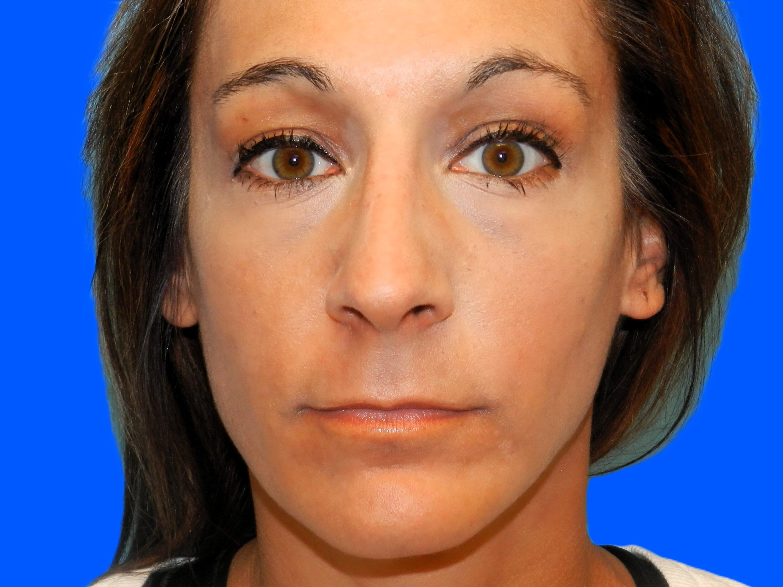 After Image: Patient Case #0108 - front