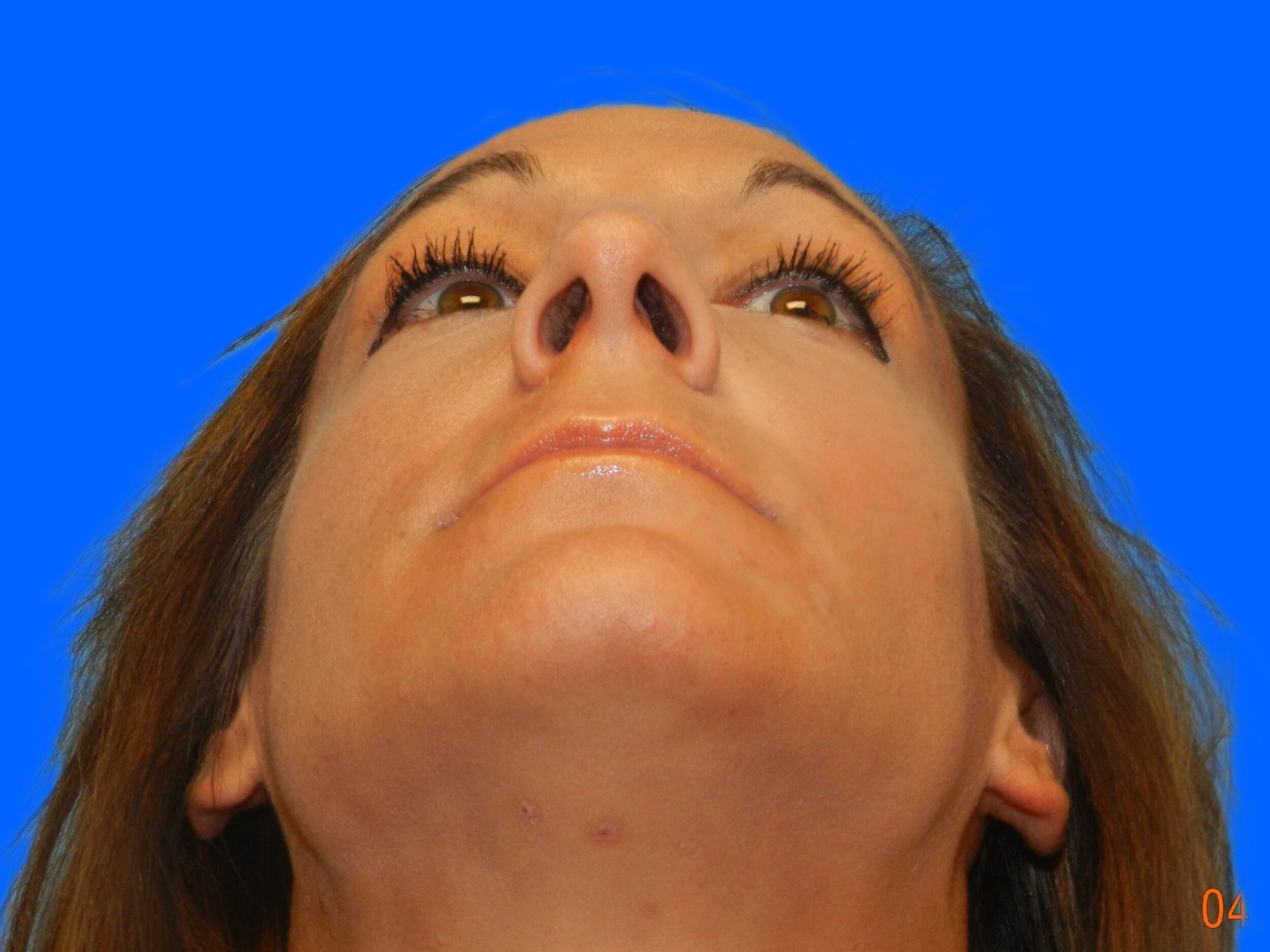 After Image: Patient Case #0108 - front