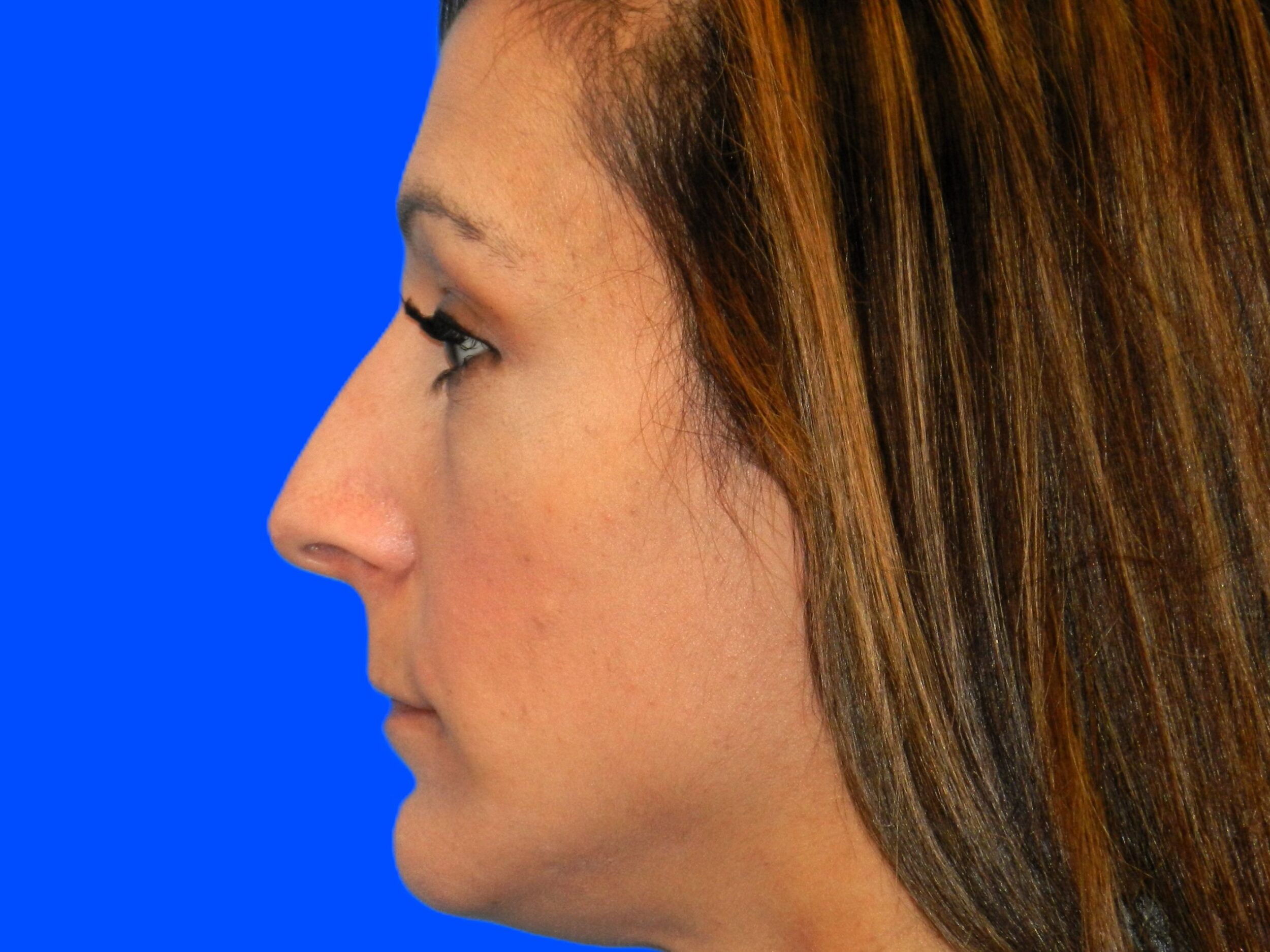 Before Image: Patient Case #0108 - left-side