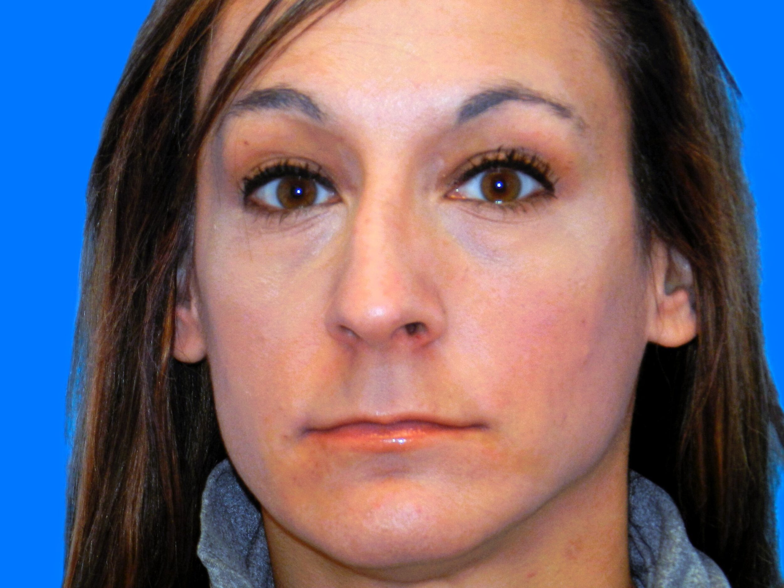 Before Image: Patient Case #0108 - front