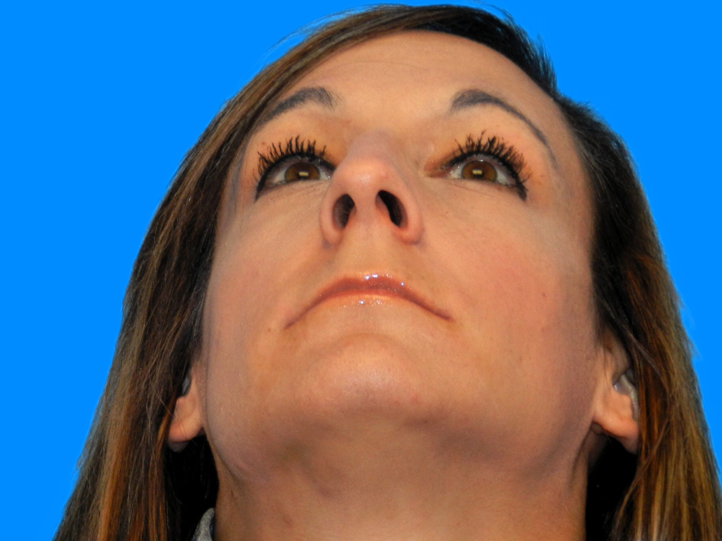 Before Image: Patient Case #0108 - front