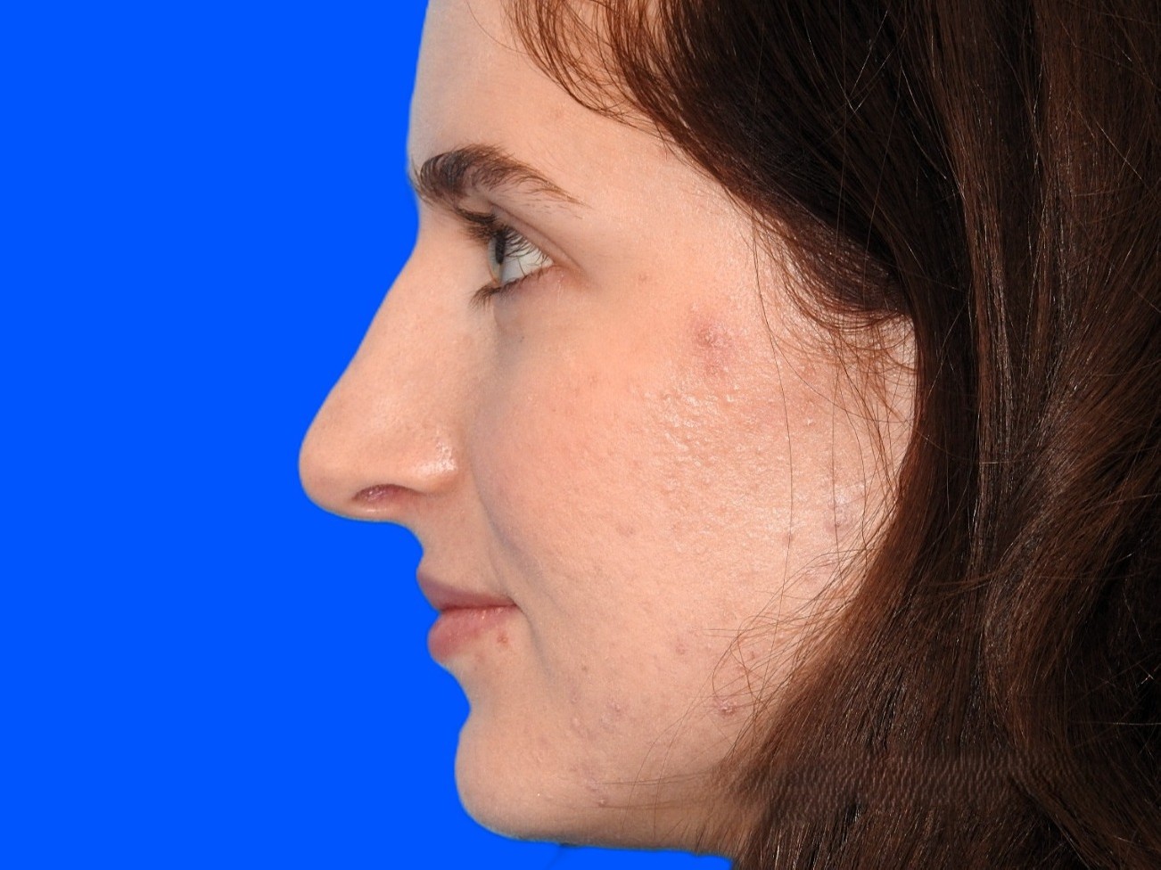 After Image: Patient Case #0109 - left-side