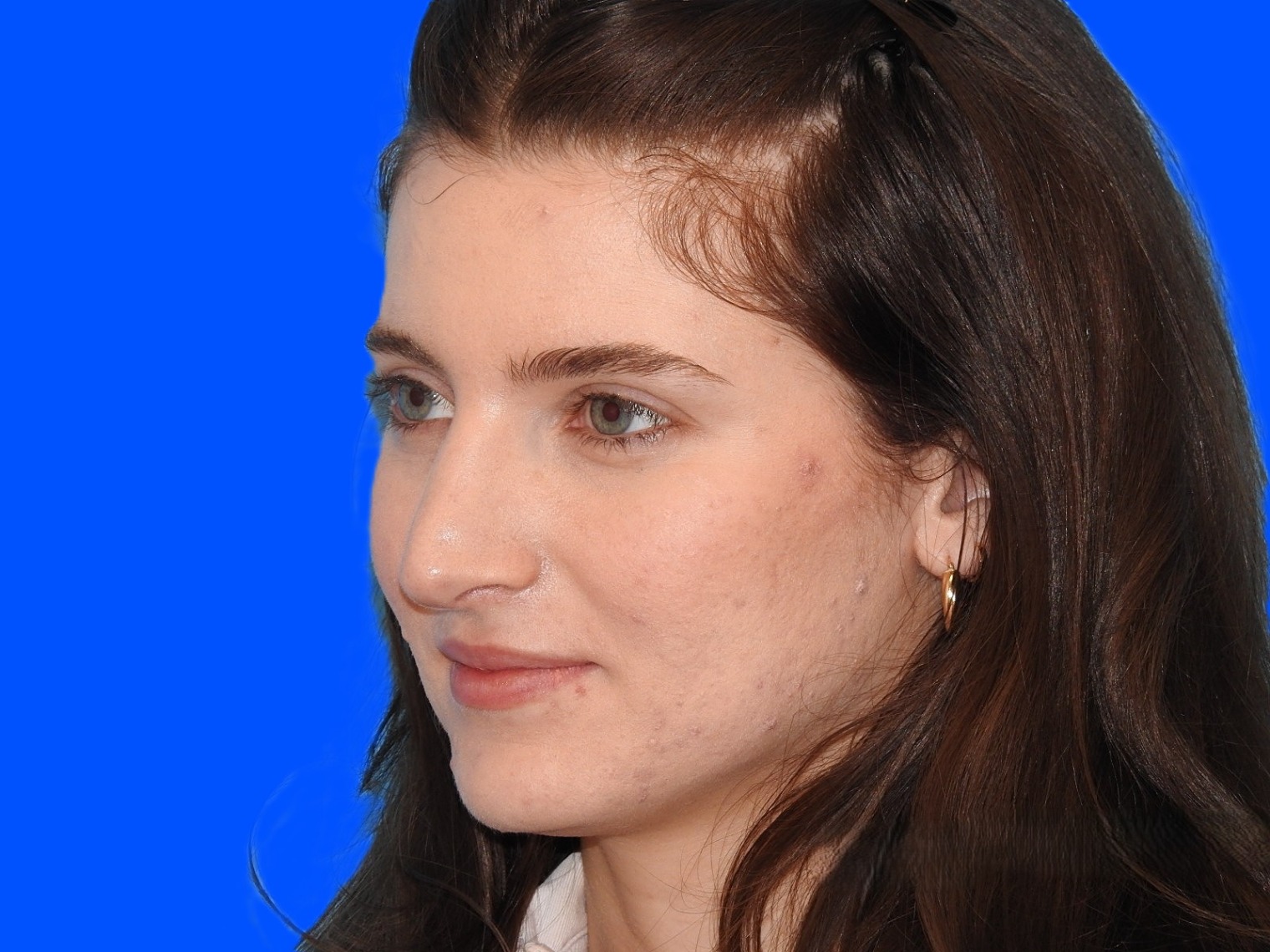 After Image: Patient Case #0109 - left-front-oblique