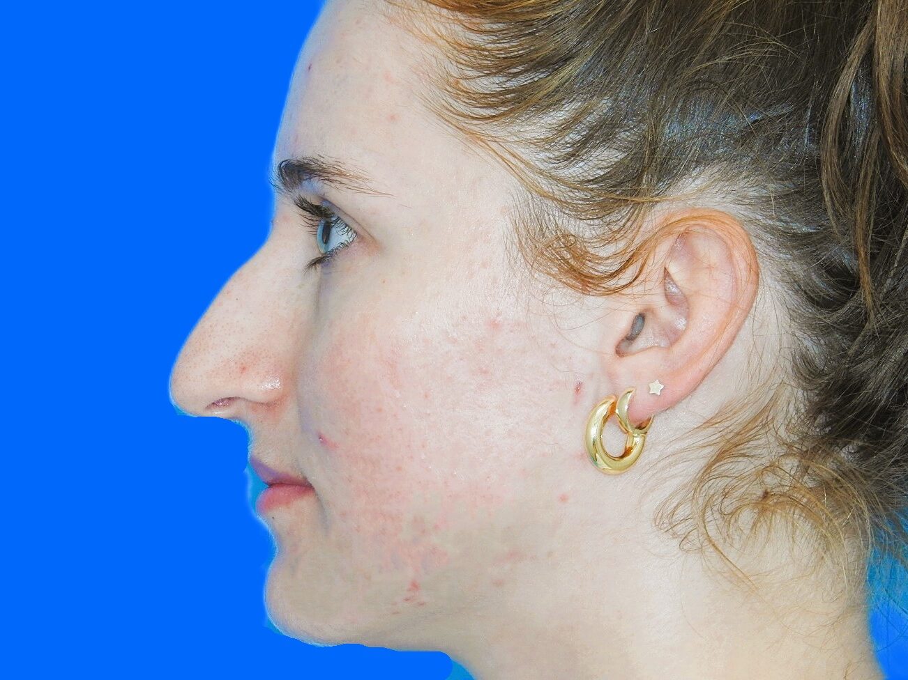 Before Image: Patient Case #0109 - left-side