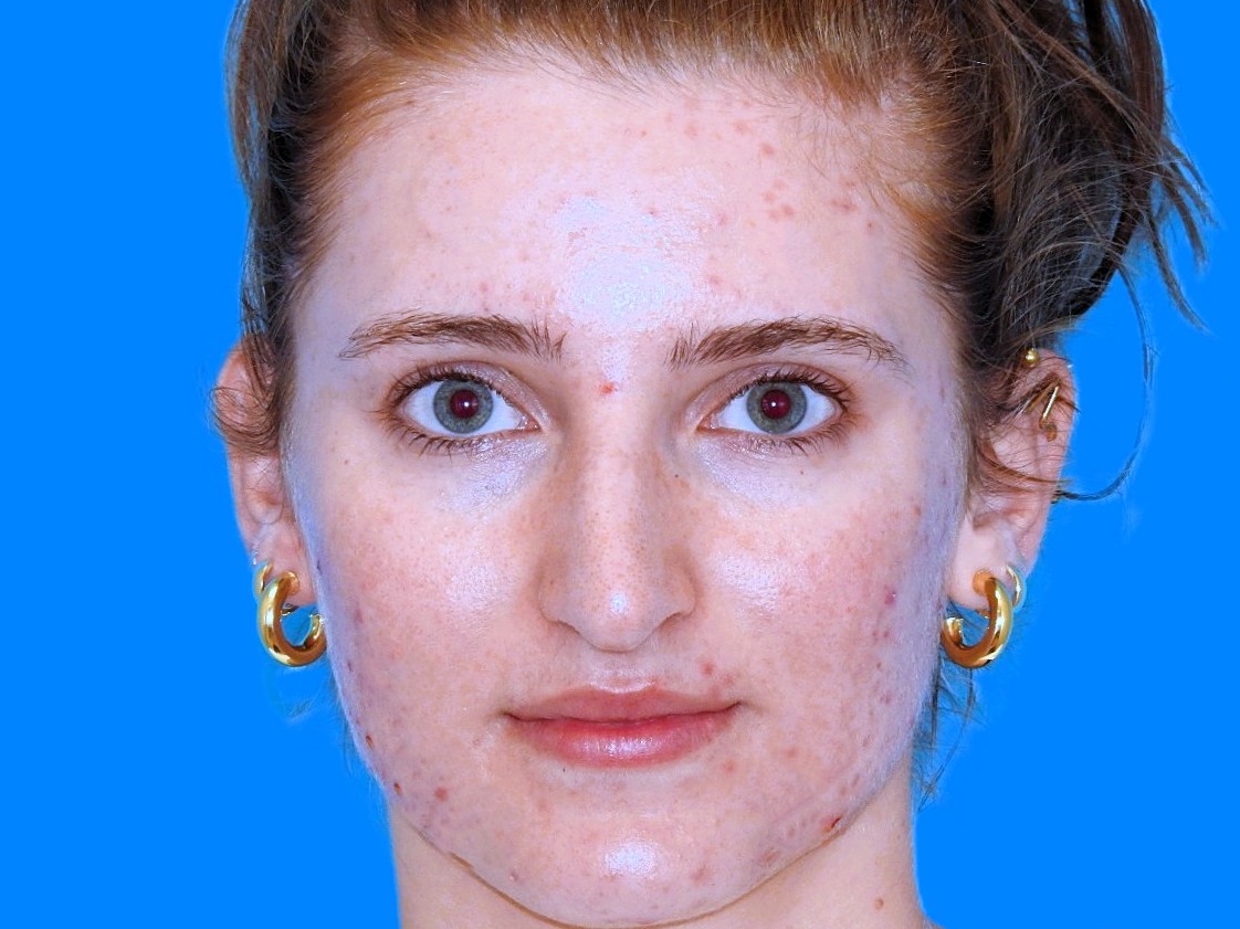 Before Image: Patient Case #0109 - front