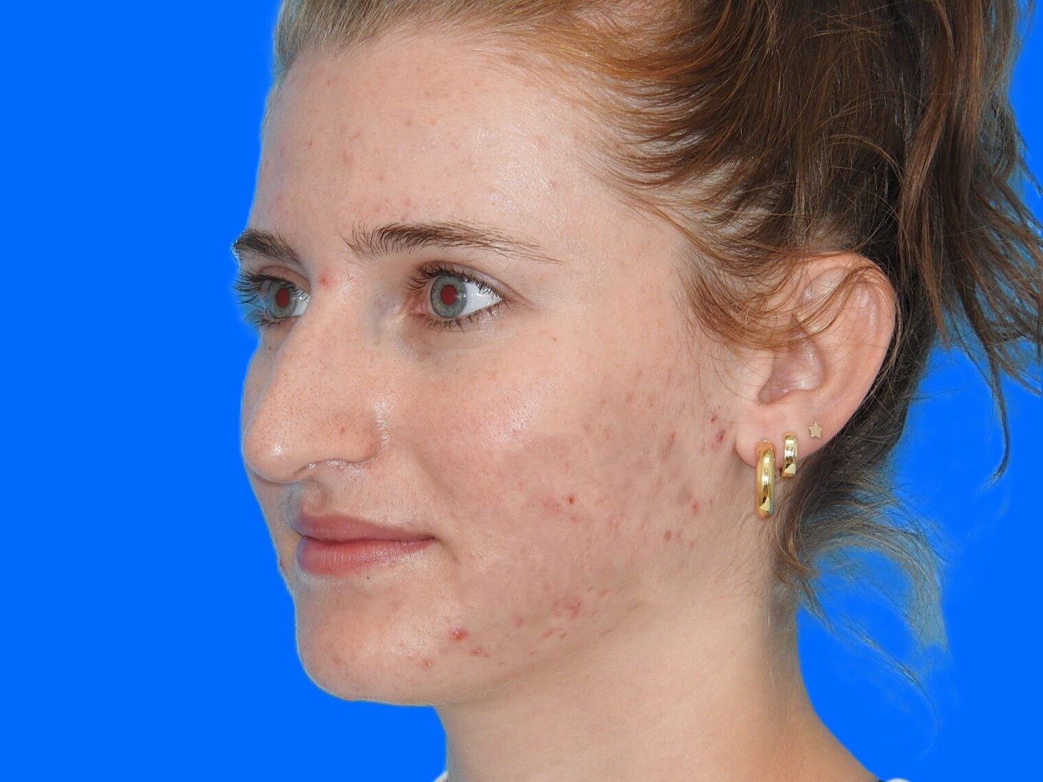 Before Image: Patient Case #0109 - left-front-oblique