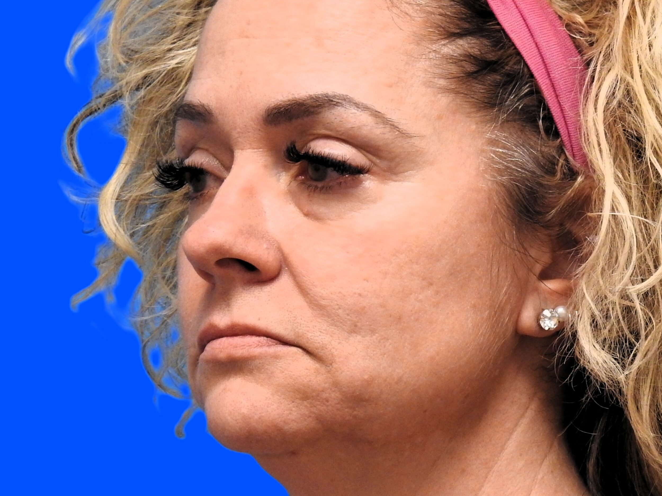 Before Image: Patient Case #0110 - left-front-oblique