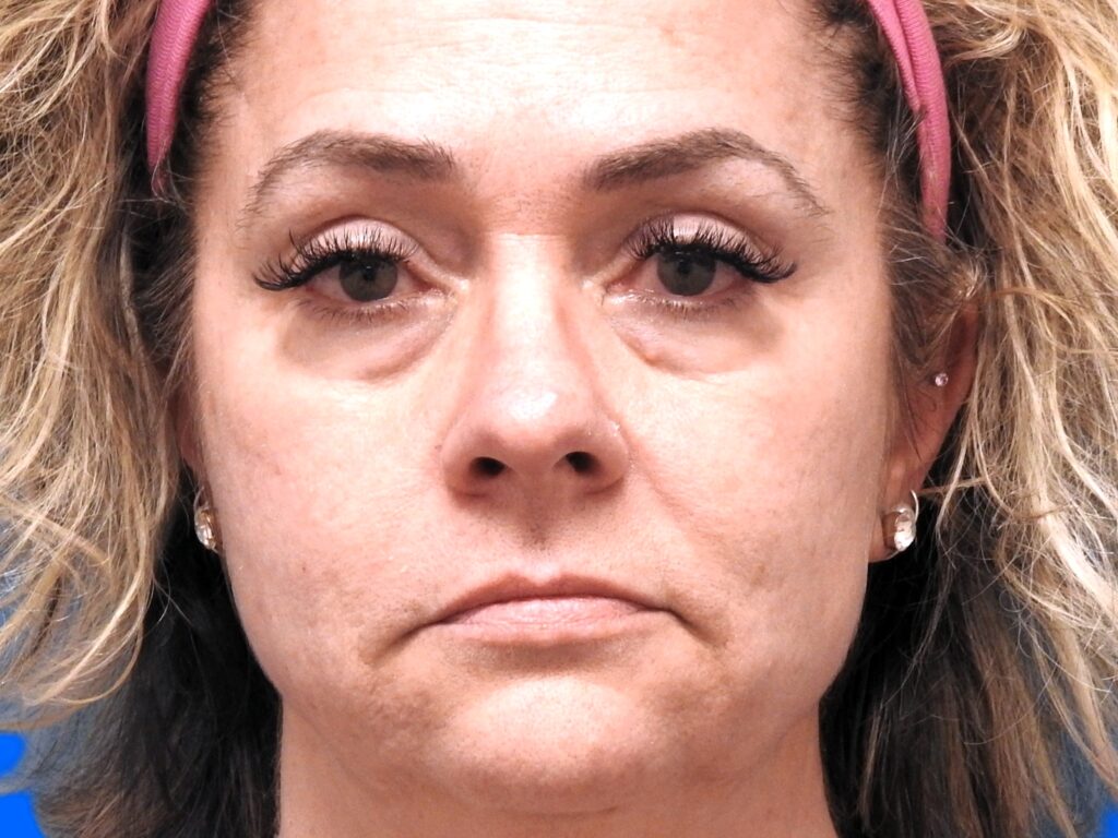 Before Image: Patient Case #0110 - front
