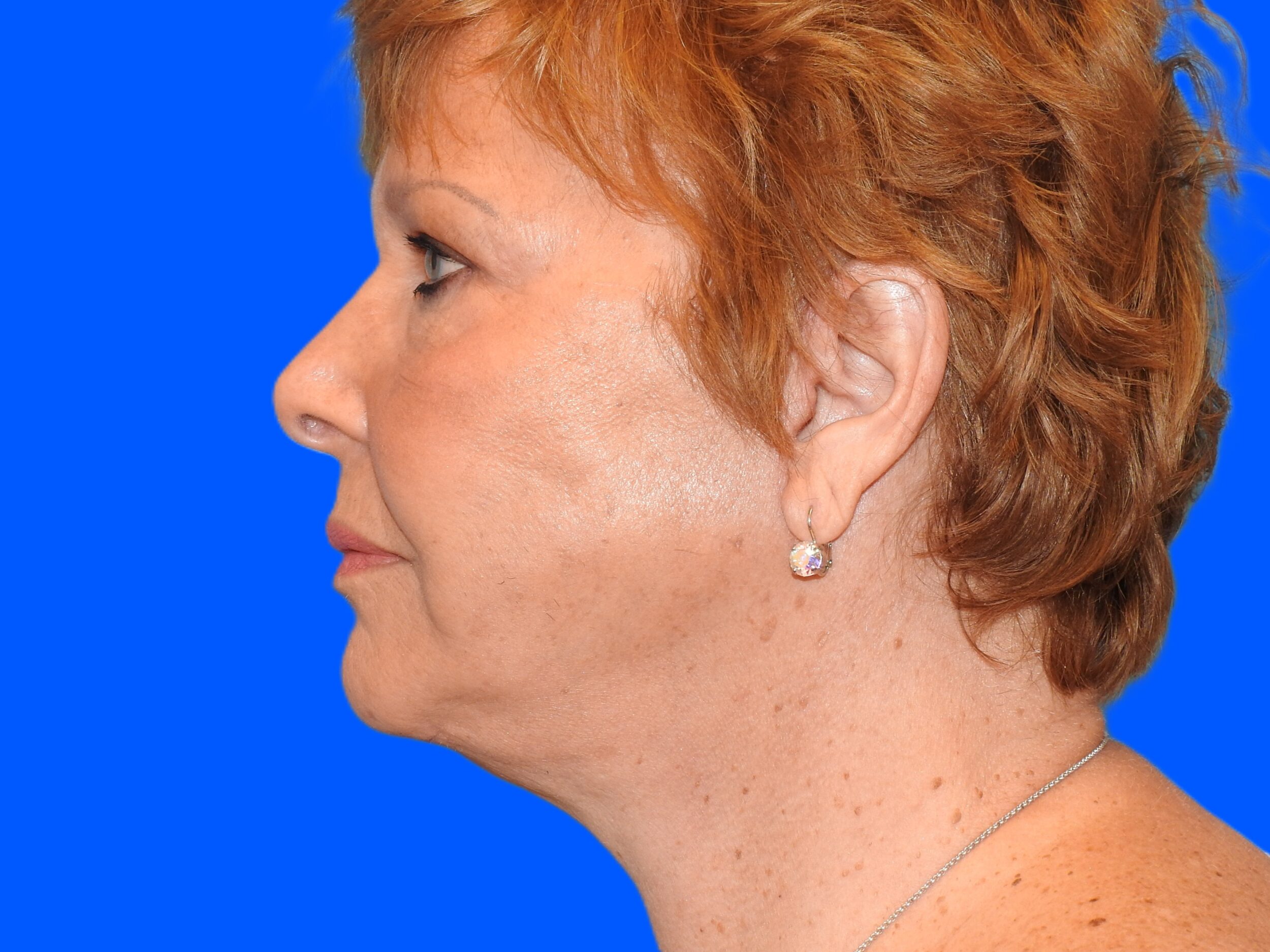 After Image: Patient Case #0111 - left-side