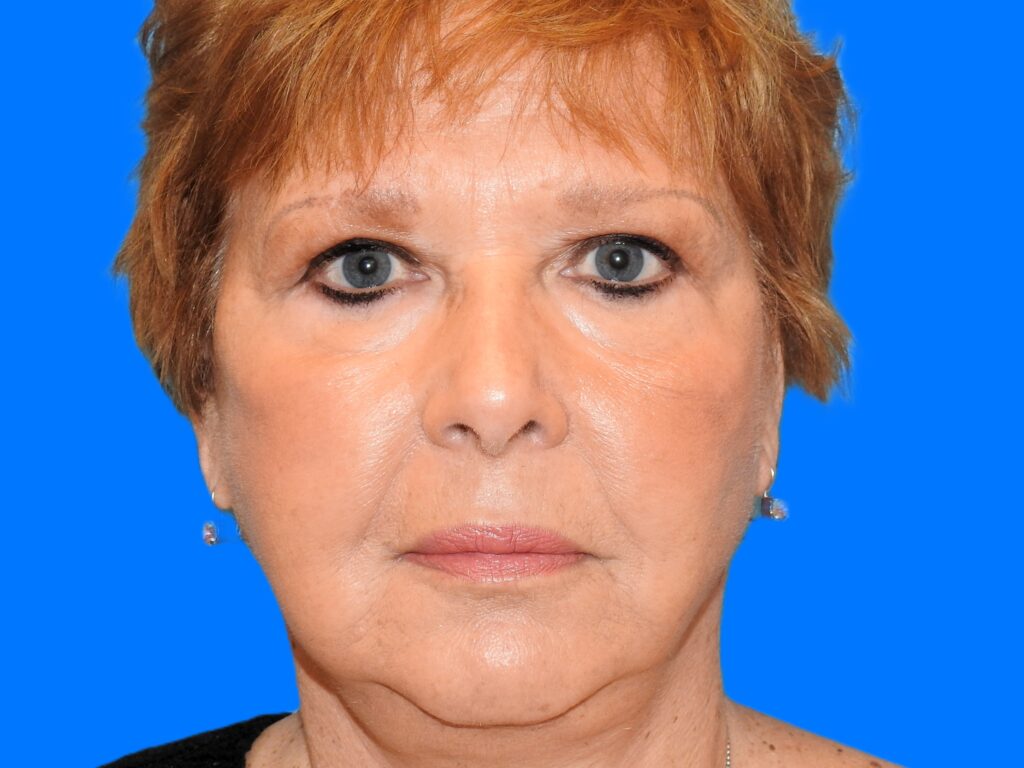 After Image: Patient Case #0111 - front