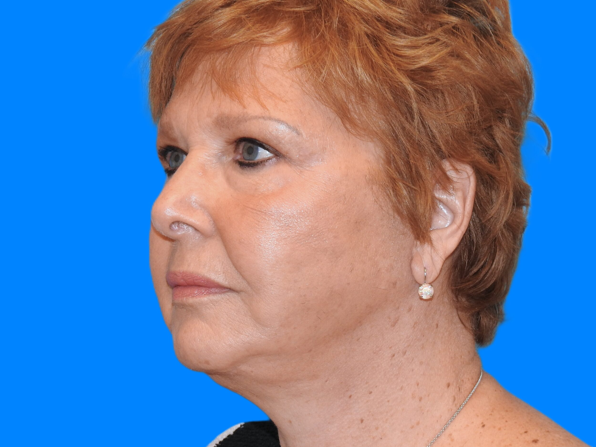 After Image: Patient Case #0111 - left-front-oblique