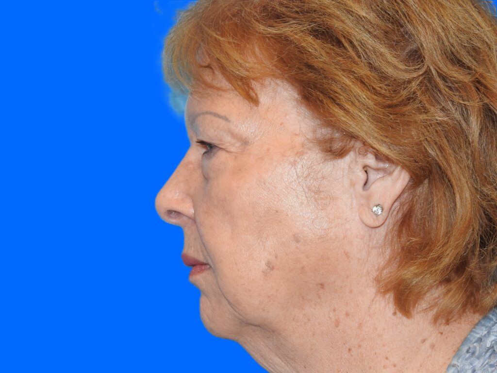 Before Image: Patient Case #0111 - left-side