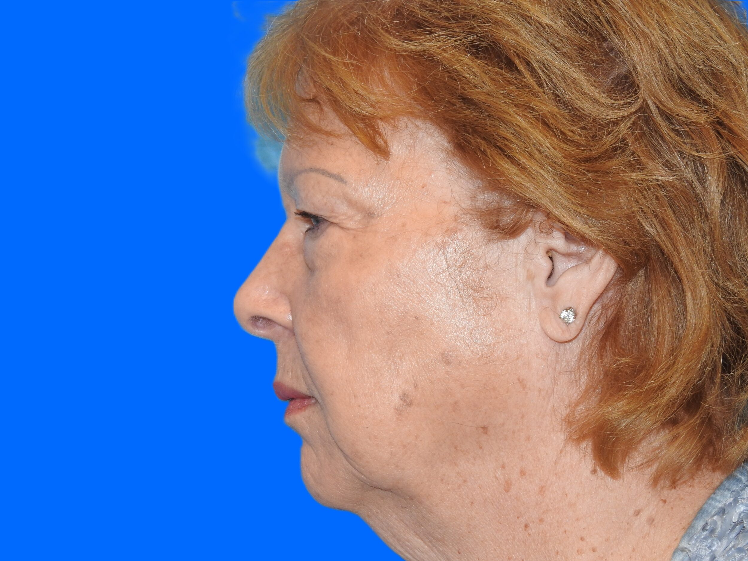 Before Image: Patient Case #0111 - left-side