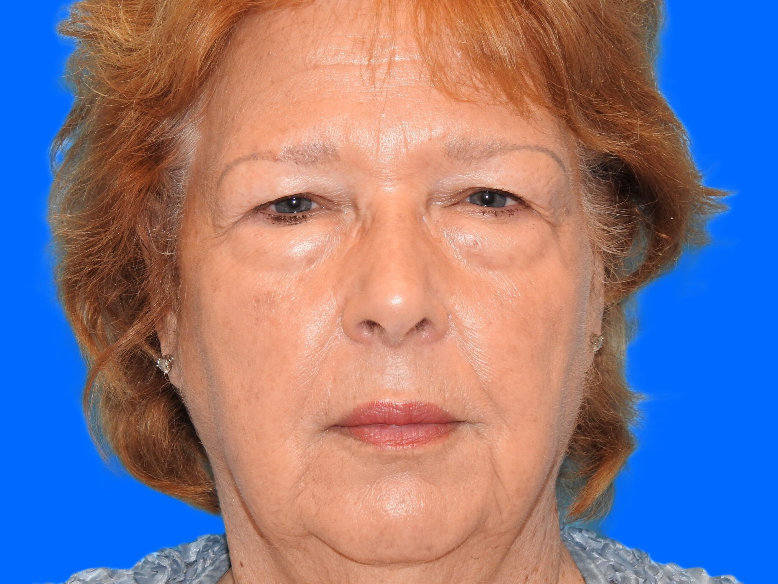 Before Image: Patient Case #0111 - front