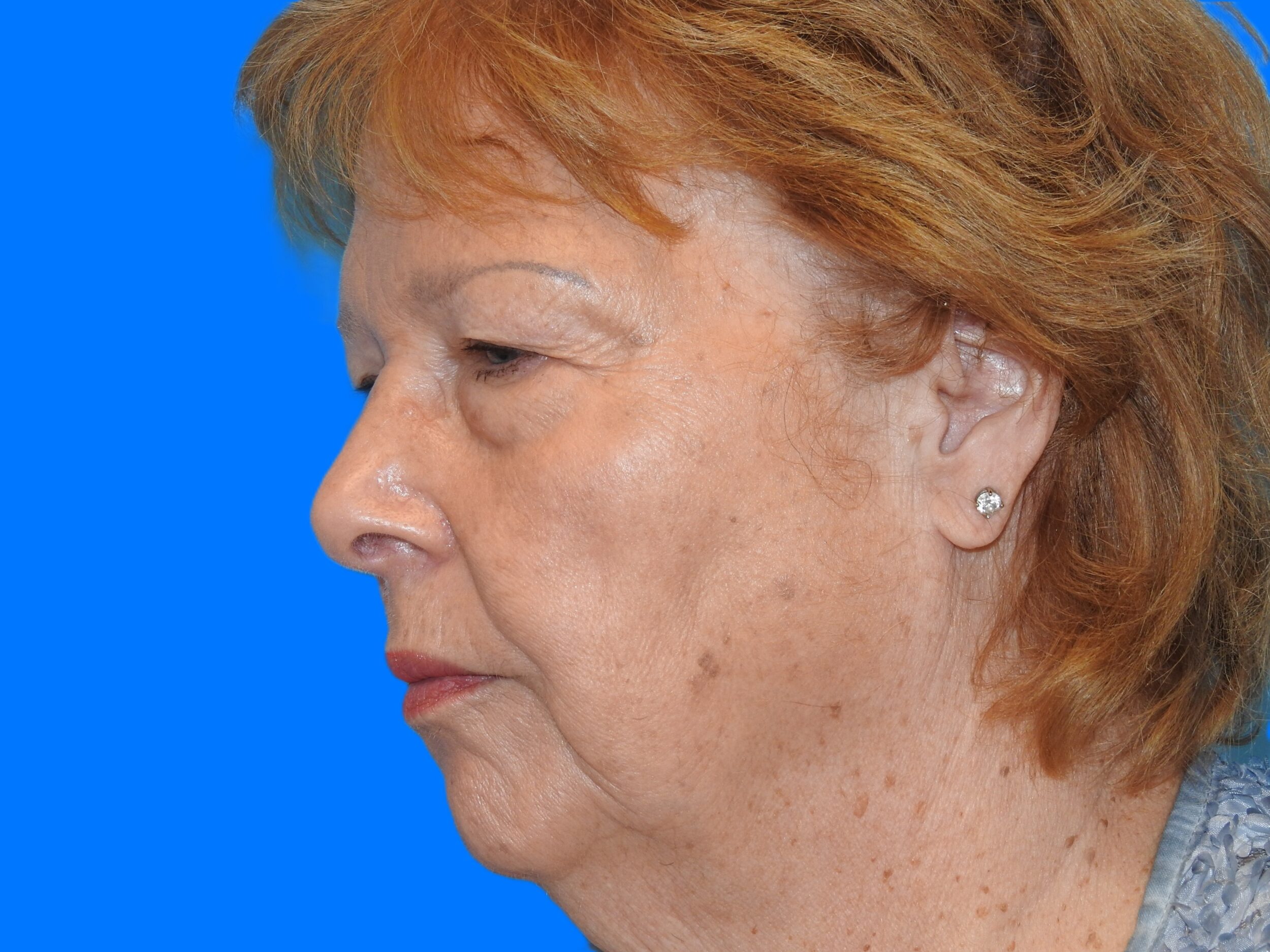 Before Image: Patient Case #0111 - left-front-oblique