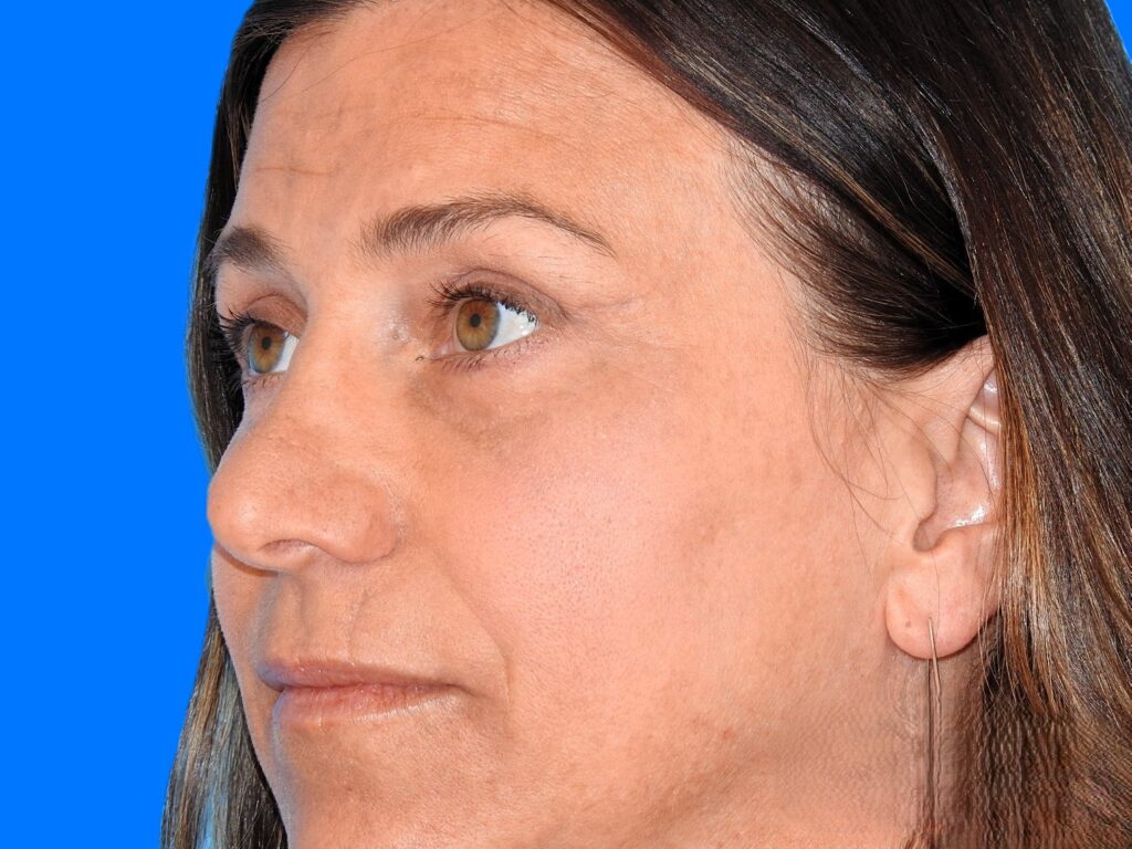 After Image: Patient Case #0112 - left-front-oblique