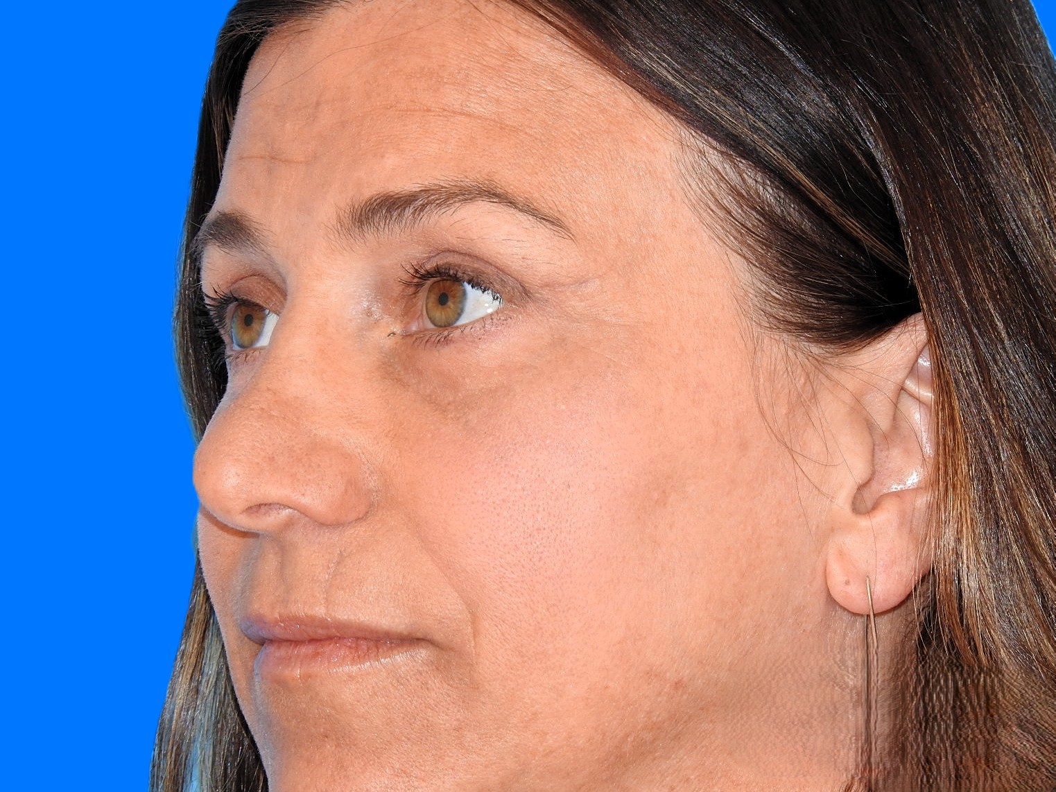 After Image: Patient Case #0112 - left-front-oblique