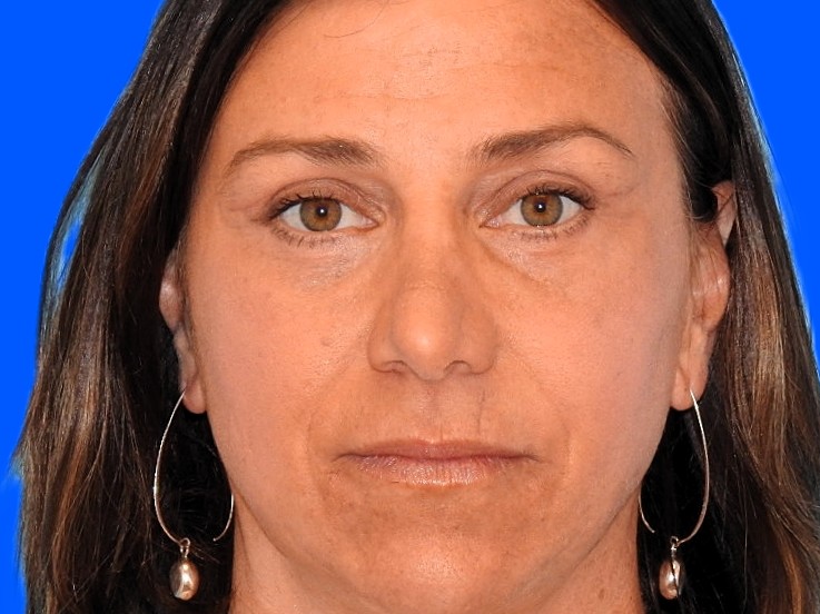 After Image: Patient Case #0112 - front