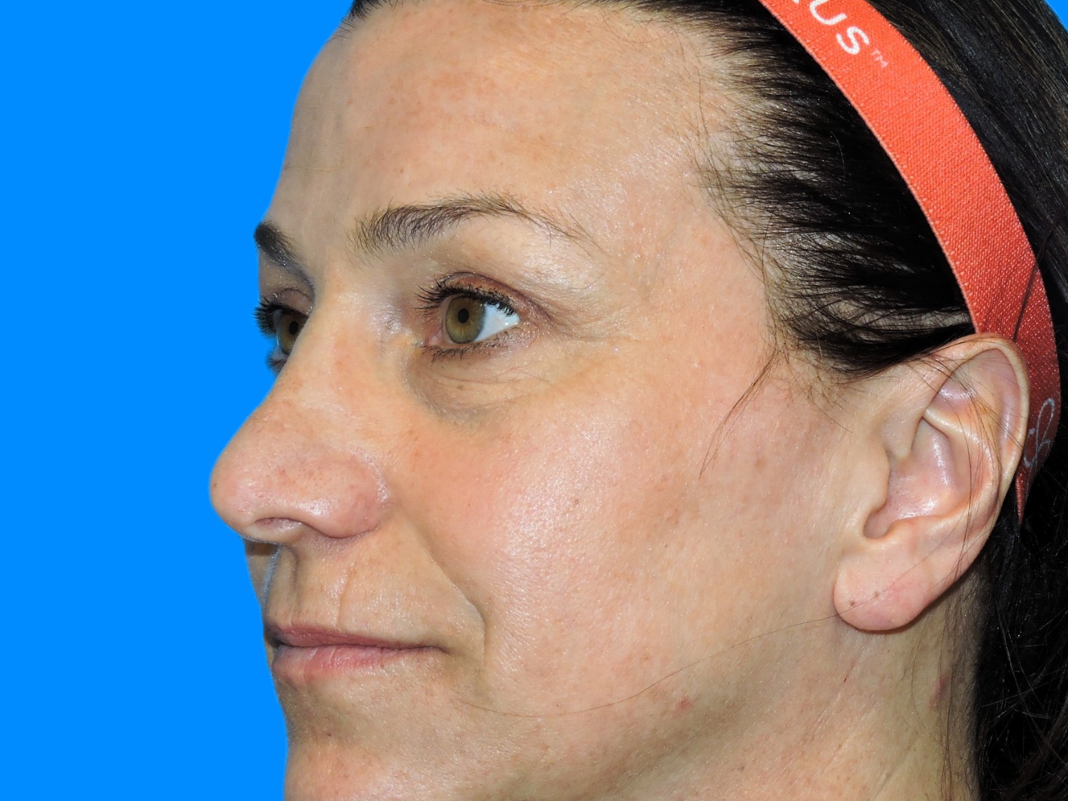 Before Image: Patient Case #0112 - left-front-oblique