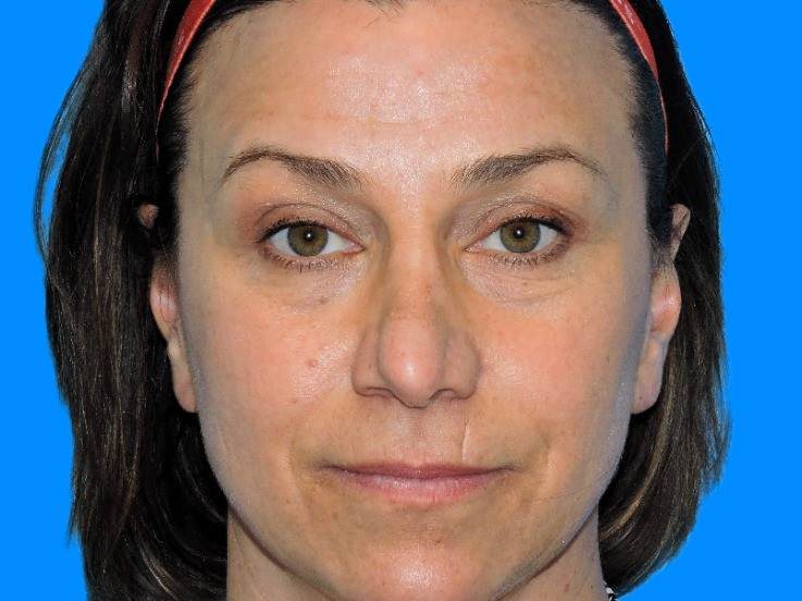 Before Image: Patient Case #0112 - front