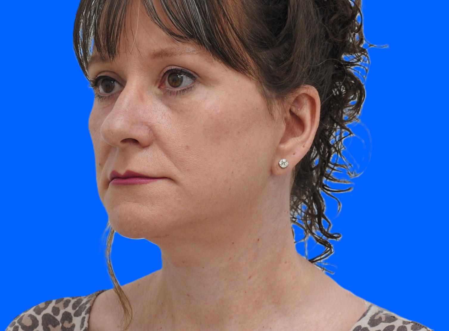 After Image: Patient Case #0113 - left-front-oblique