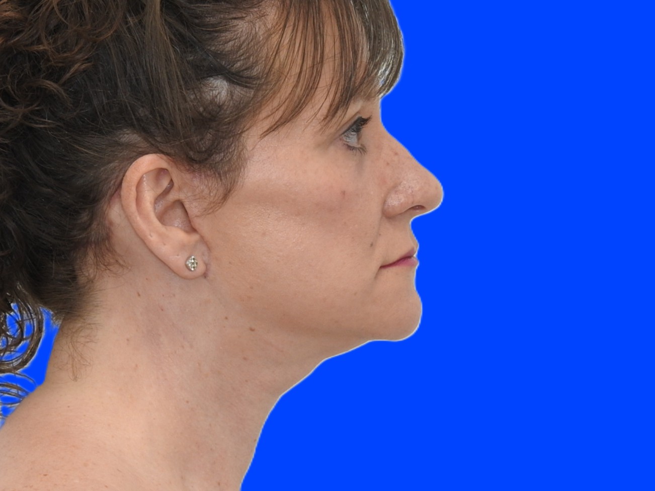 After Image: Patient Case #0113 - right-side