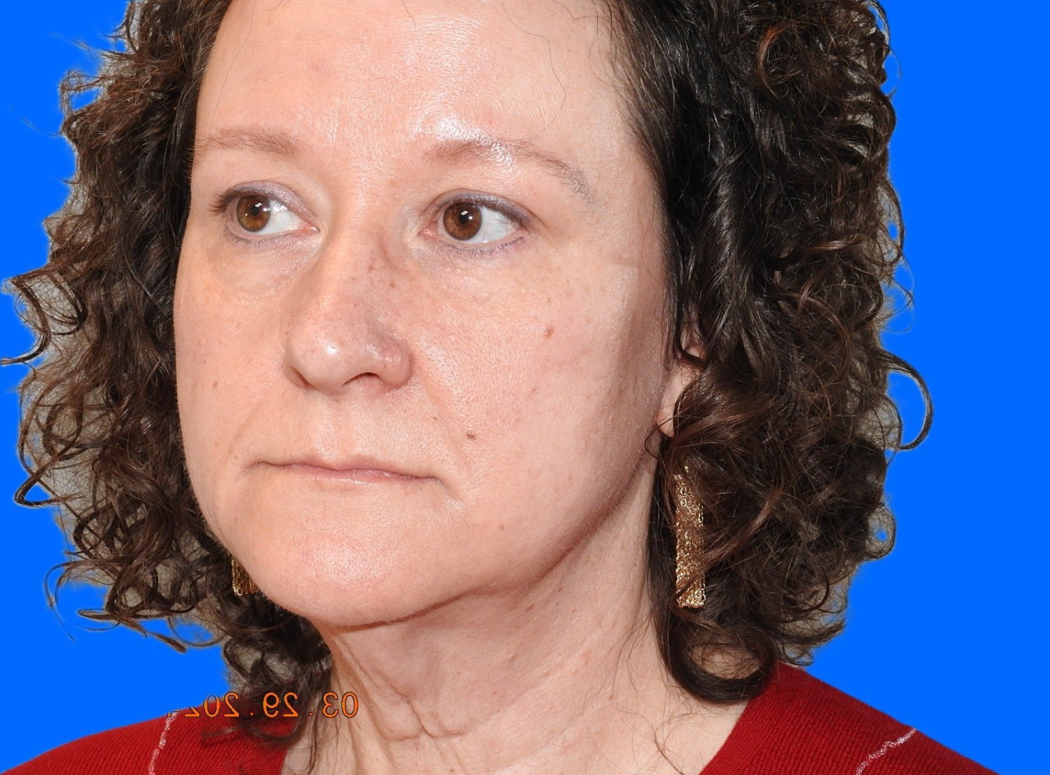 Before Image: Patient Case #0113 - left-front-oblique