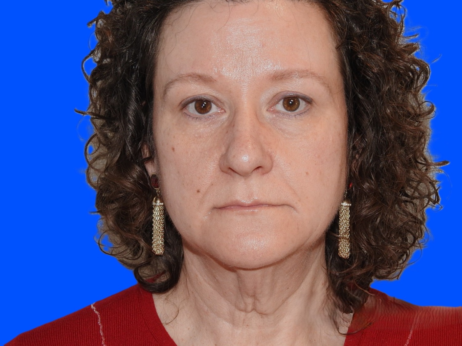 Before Image: Patient Case #0113 - front