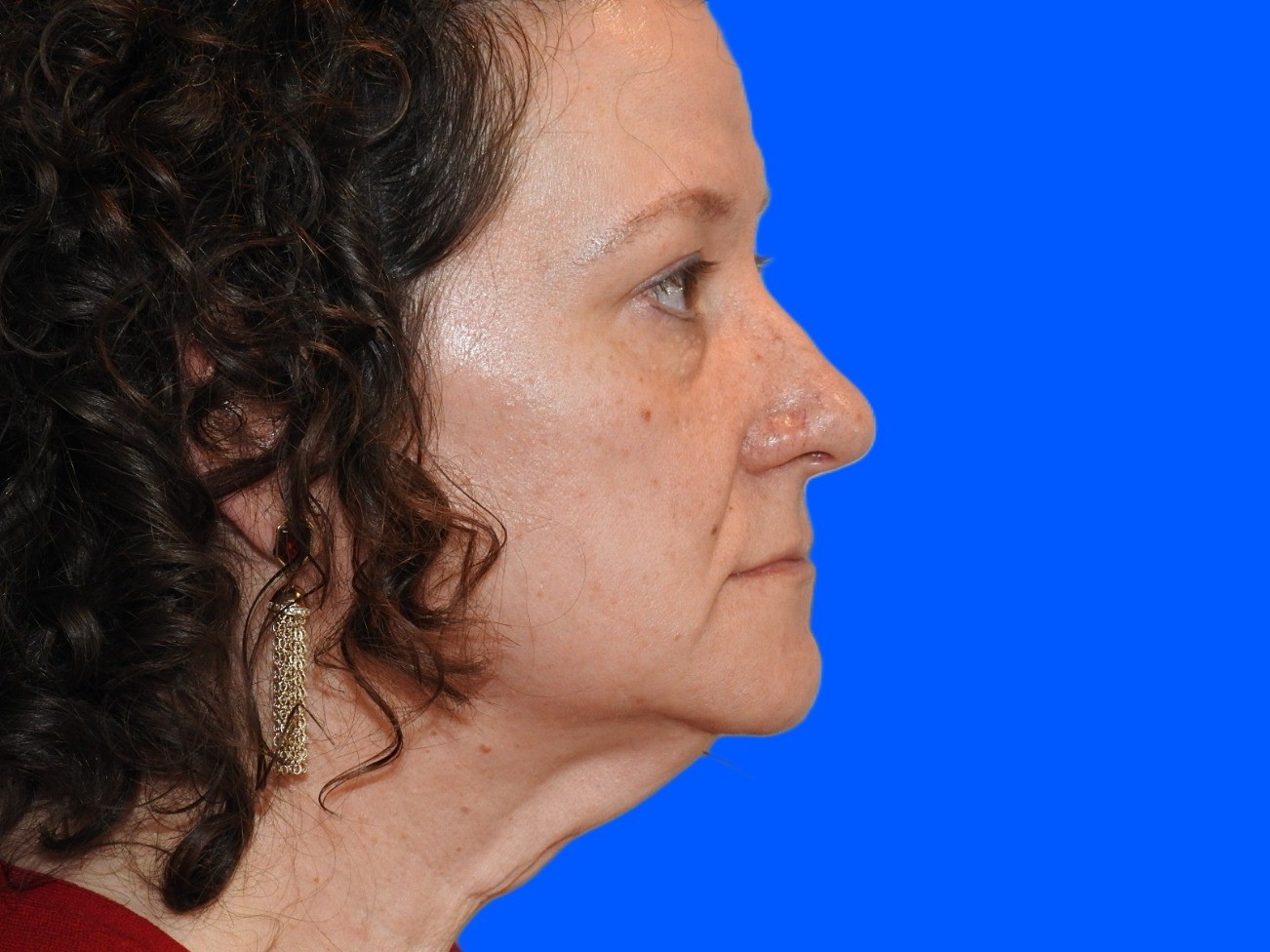 Before Image: Patient Case #0113 - right-side