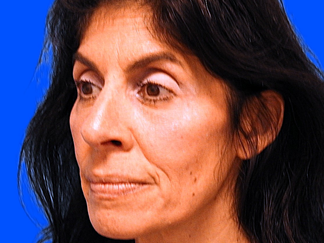 After Image: Patient Case #0114 - left-front-oblique